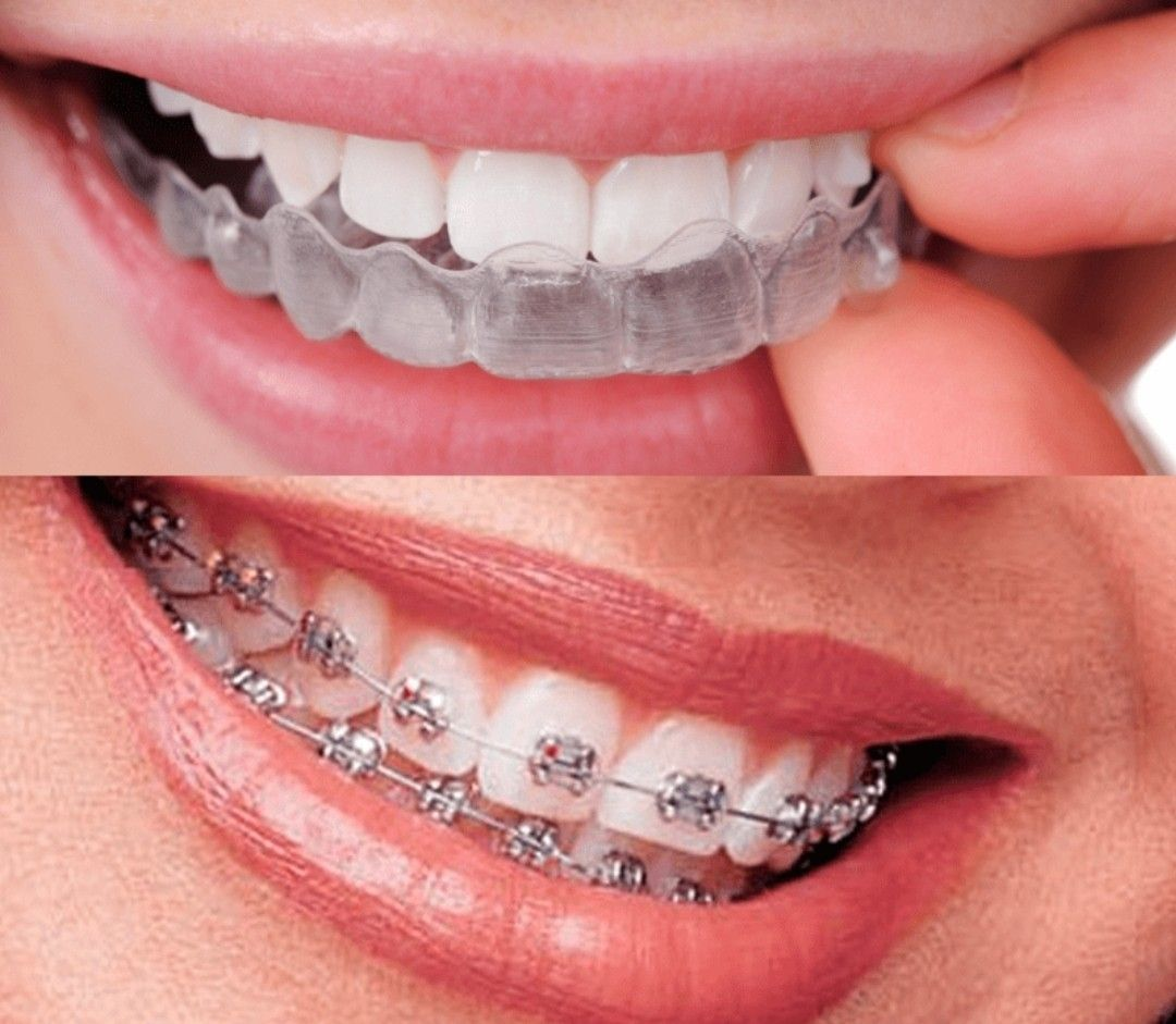 Invisalign vs. Traditional Braces: Which is Right for You?